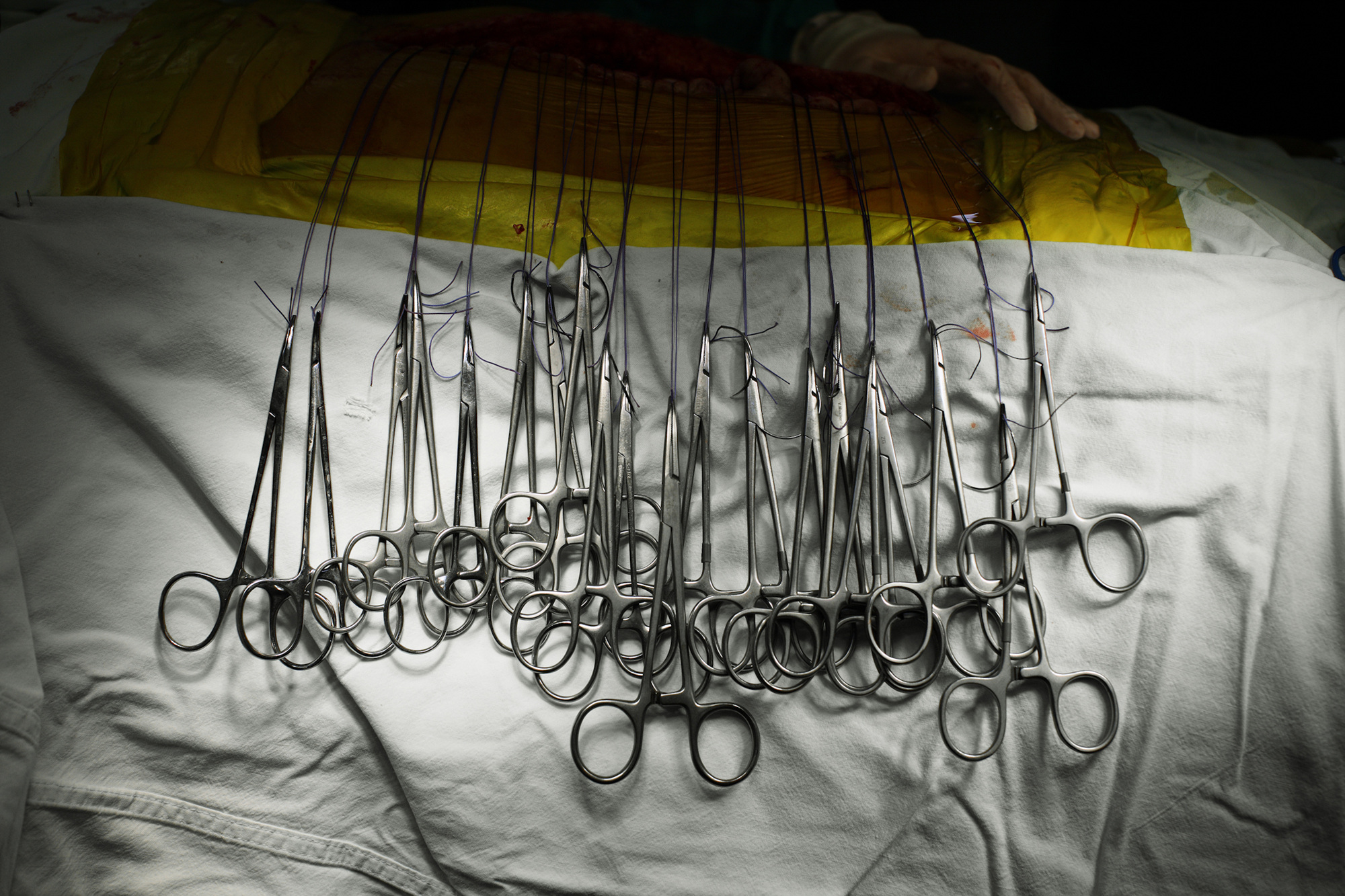 02 Surgical stitches, 2008