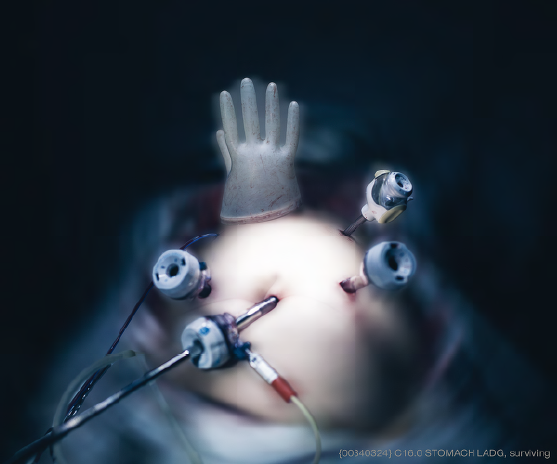 JSN-49 Retractors in situ #02 2014