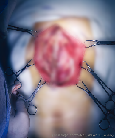 JSN-50 Retractors in situ #03 2014