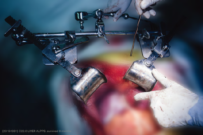 JSN-51 Retractors in situ #04 2014